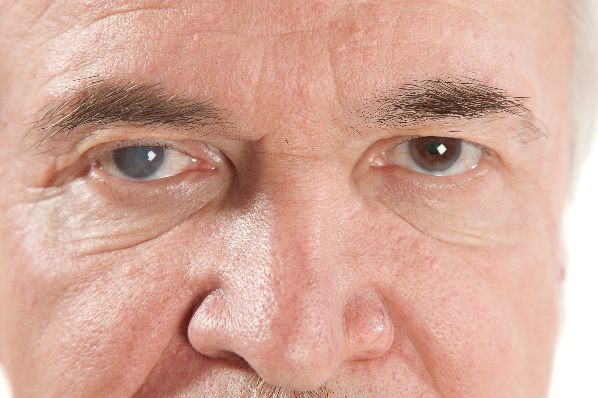 cataract eye disease eye conditon cataracts