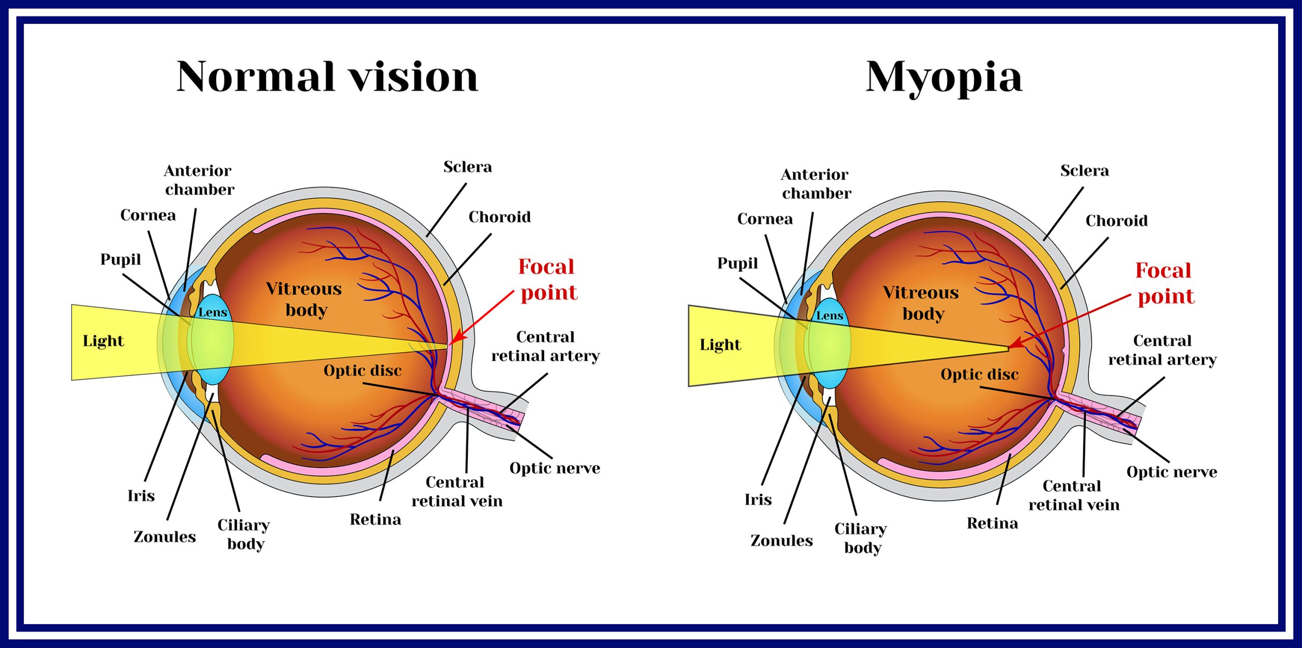 Refractive errors eyeball. Myopia. What is Myopia?