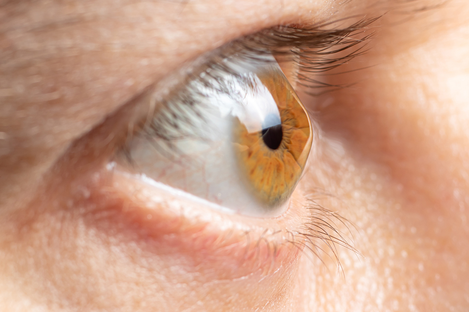 Keratoconus