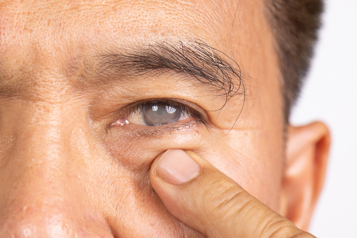 cataract in the eye of a man