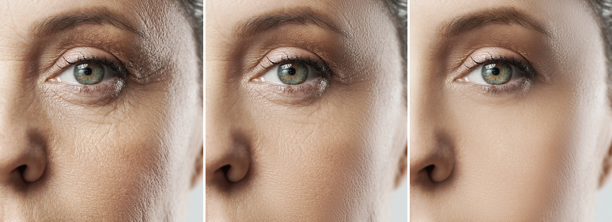 Tixel delicate skin rejuvenation Tixel skin rejuvenation for delicate facial areas